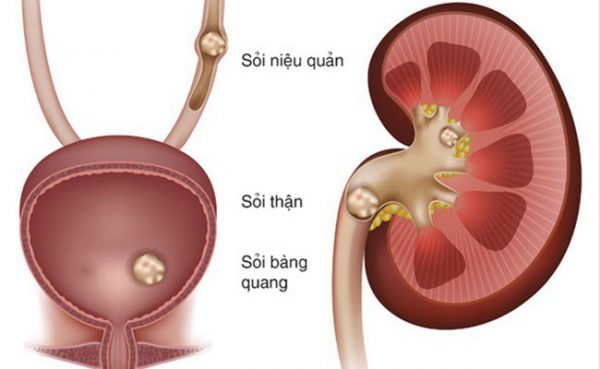 Sỏi thận là hiện tượng chất khoáng trong nước tiểu lắng đọng lại ở thận, lâu ngày kết lại tạo thành sỏi (ảnh minh họa)