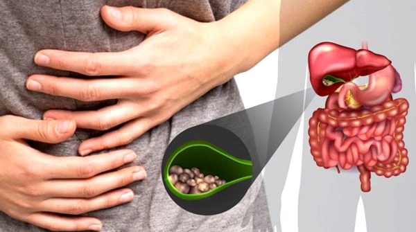Sỏi mật hình thành do cholesterol không được hòa tan hết và lâu dần kết tụ lại thành sỏi (ảnh minh họa)