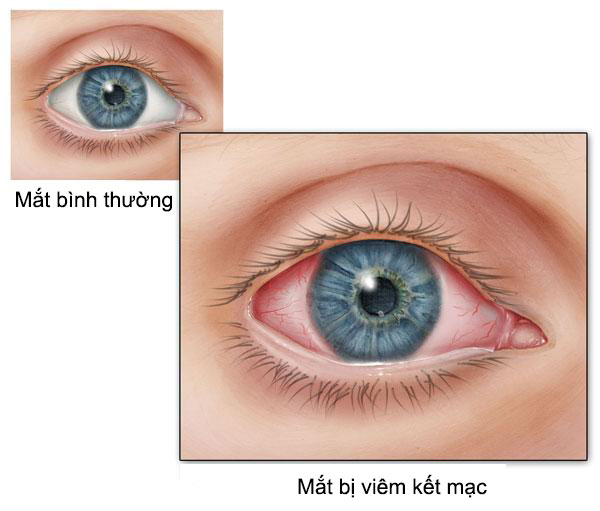 Chớ coi thường bệnh viêm kết mạc mắt | TCI Hospital