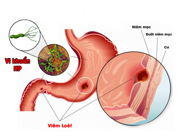 Vi khuẩn Hp là "thủ phạm" chính gây viêm loét dạ dày (ảnh minh họa)
