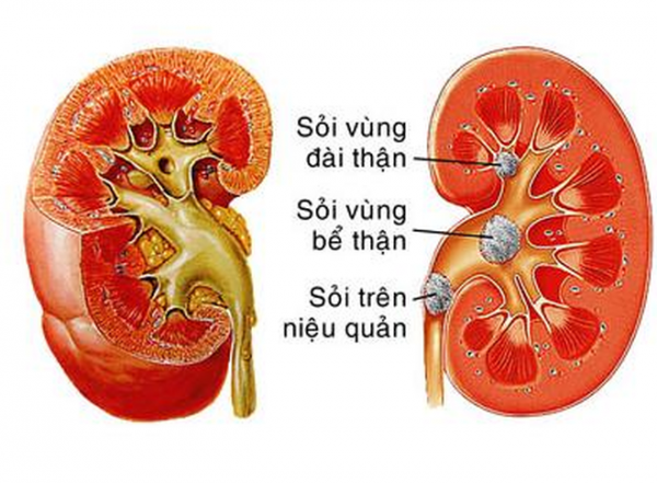 Cặn thận gây sỏi thận