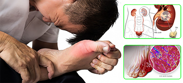 Bệnh nhân mắc bệnh gout bị sỏi thận do chính tinh thể urate lắng đọng gây ra làm tắc nghẽn đường tiết niệu (ảnh minh họa)