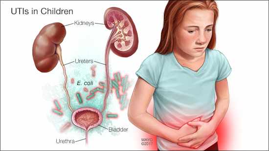 nhiễm trùng tiểu ở trẻ em