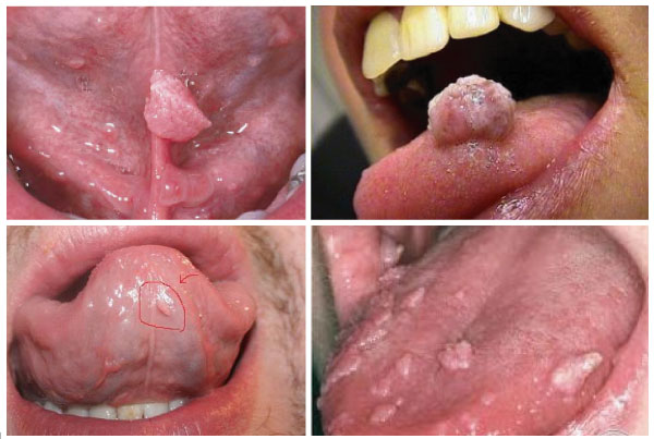 Những biểu hiện của sùi mào gà ở cuống lưỡi | TCI Hospital
