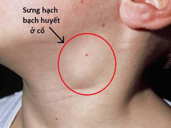 Sưng hạch bạch huyết ở cổ: Nguyên nhân, triệu chứng và cách điều trị