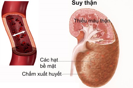 suy thận do viêm đường tiểu