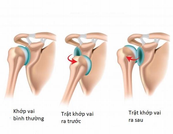 Khớp vai là khớp di động nhất của cơ thể, vì thế rất dễ bị trật.
