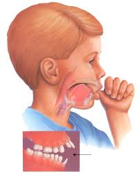 trẻ mút tay gây biến dạng răng, hàm