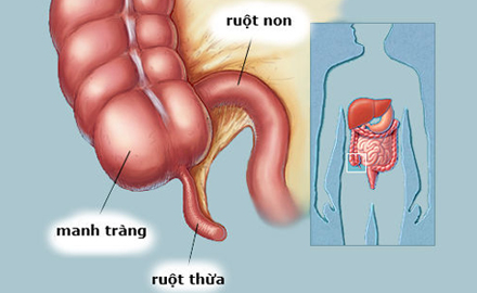 viêm ruột thừa ở trẻ em 