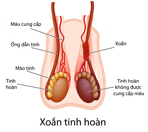 xoắn tinh hoàn ở trẻ em không được xử trí kịp thời có thể phải cắt bỏ tinh hoàn
