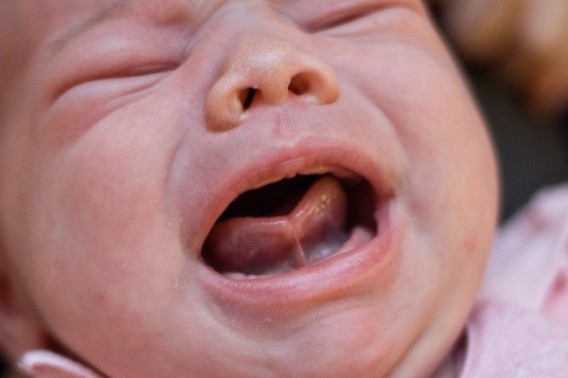 Dính phanh lưỡi ở trẻ em gồm 4 mức độ. 