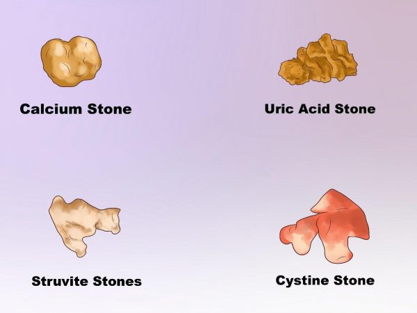 sỏi Những người mặc bệnh gout có thể dẫn đến sỏi thận acid uric