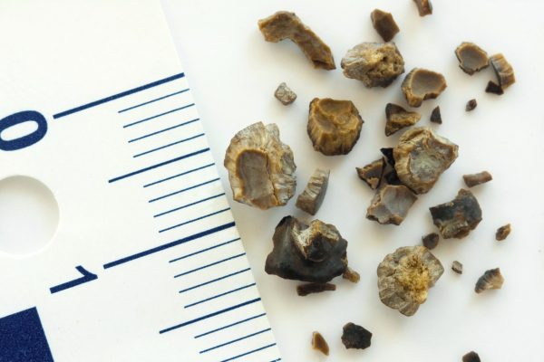 Sỏi thận là gì?
