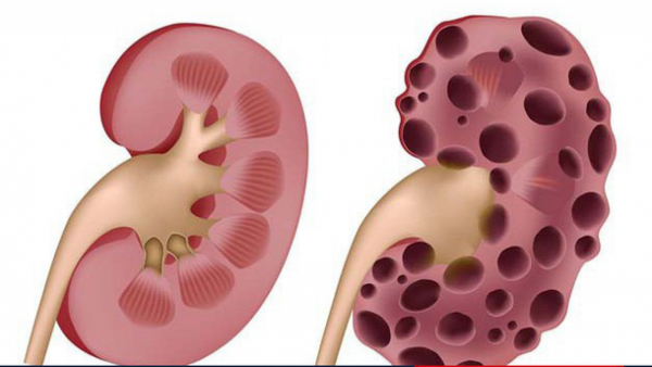 Điều trị sỏi hệ tiết niệu như thế nào