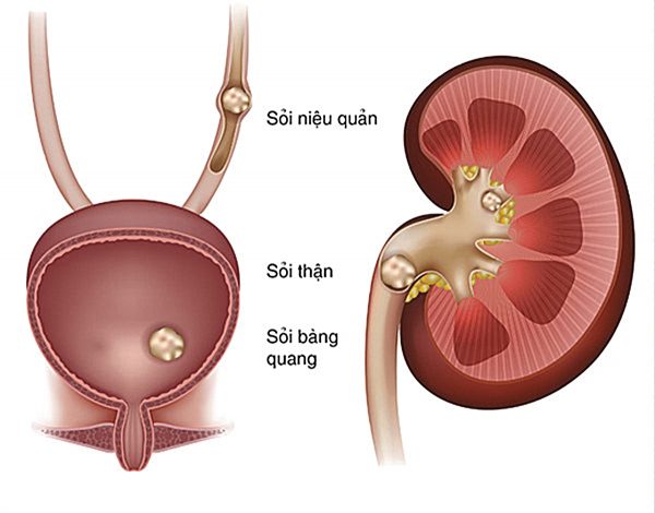 soi tiet nieu co tu bai tiet qua duong nuoc tieu khong