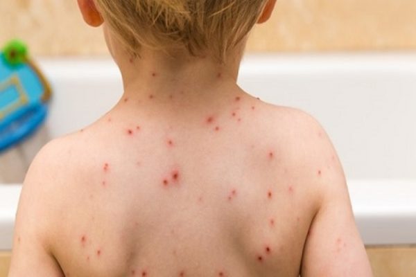 Trẻ nhỏ thường dễ gặp các bệnh ngoài da bởi lúc này sức đề kháng của trẻ vẫn chưa được hoàn thiện