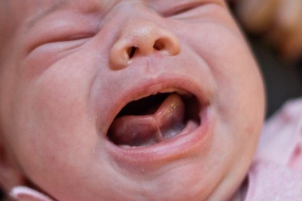Dính phần màng mỏng gần đầu lưỡi là loại dính thắng lưỡi phổ biến nhất