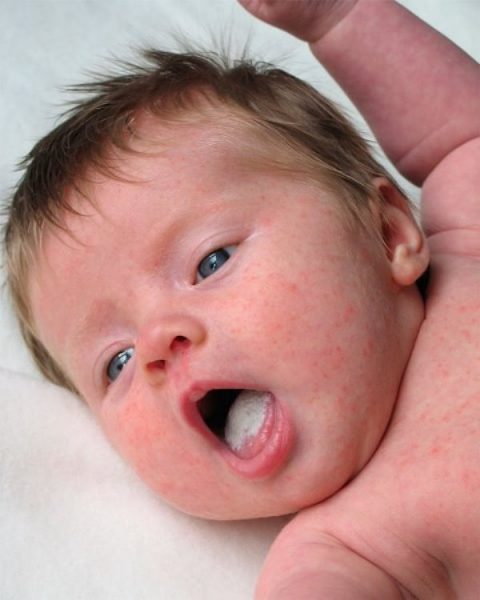nấm da khiến trẻ bị nổi mẩn đỏ như muỗi đốt