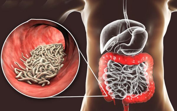 Bệnh kiết lỵ là gì?
