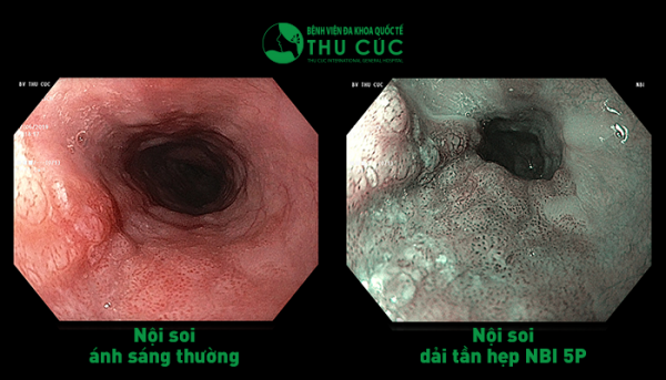 Công nghệ nội soi dải tần ánh sáng hẹp NBI 5P cho phép quan sát chi tiết các mô dưới lớp niêm mạc, phát hiện ung thư ở giai đoạn rất sớm