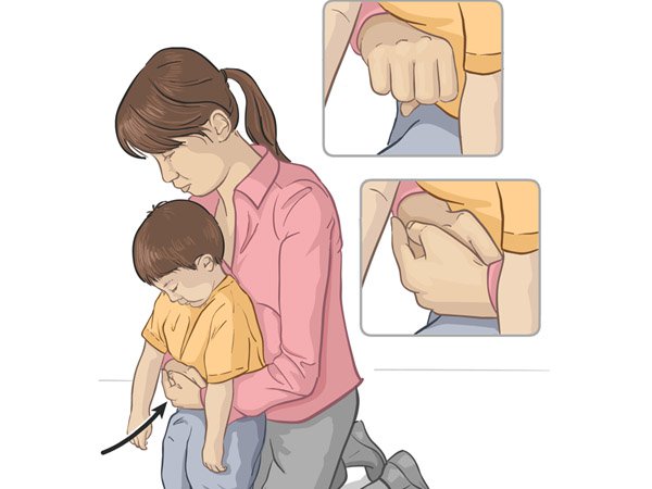 Phương pháp Heimlich