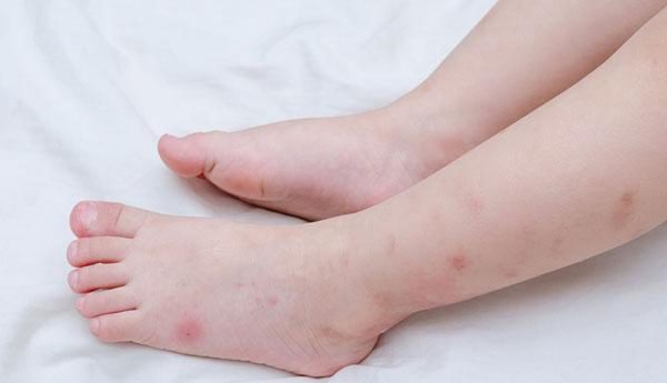 Những nốt muỗi đốt nếu bé gãi làm trầy xước da có thể gây nhiễm trùng và để lại sẹo. 