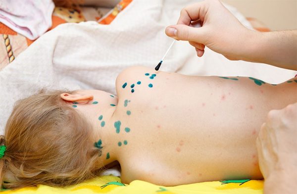 dấu hiệu bệnh thủy đậu ở trẻ em