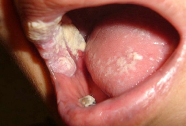 dấu hiệu bệnh lậu ở miệng