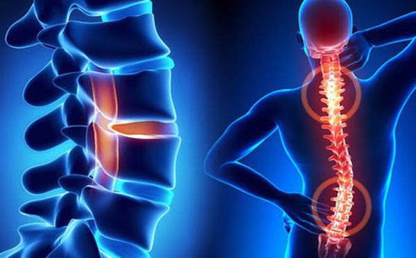 Vôi hóa cột sống do nhiều nguyên nhân khác nhau gây ra