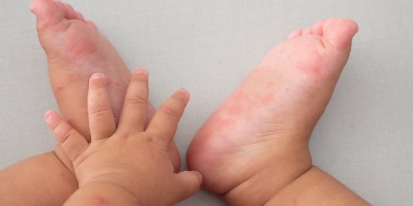 bệnh mùa nắng ở trẻ nhỏ
