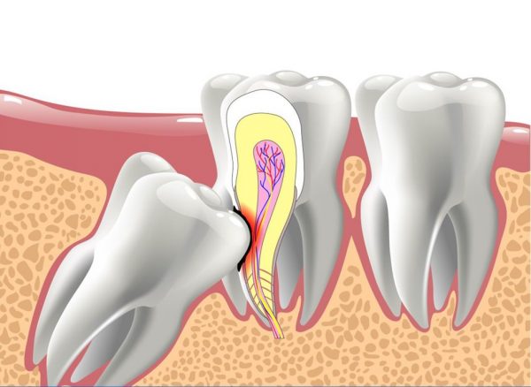  Răng khôn hay răng số 8 mọc ở vị trí trong cùng của cung hàm 