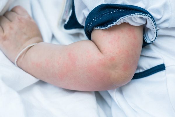 Nhấn vào ảnh để phóng to mùa nóng trẻ đến trường dễ gặp bệnh gì