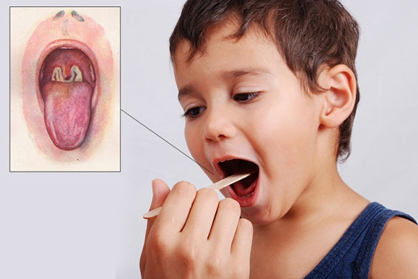 Cảnh báo] Bệnh bạch hầu ở trẻ em dễ nhầm lẫn với bệnh viêm mũi họng