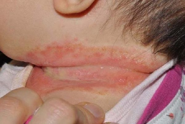 Bệnh viêm da mủ ở trẻ dễ gặp vào mùa nóng | TCI Hospital