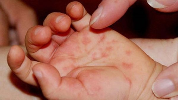 bệnh tay chân miệng là bệnh thường gặp ở trẻ vào mùa hè