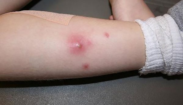 Bệnh viêm da mủ ở trẻ có nguy hiểm không