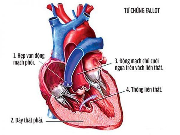 Đừng bỏ qua dấu hiệu nhận biết bệnh tim bẩm sinh ở trẻ em