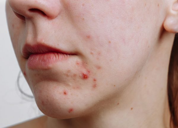 Hệ quả cơ thể bạn bị thiếu dinh dưỡng