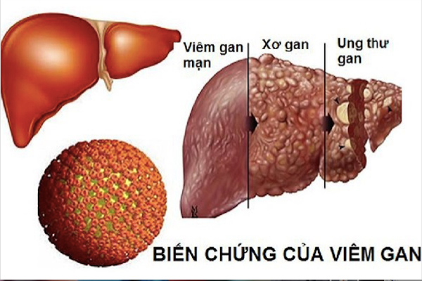 Viêm gan B mạn tính rất dễ dẫn đến xơ gan và ung thư gan. 80% ca ung thư gan ở Việt Nam có nhiễm virus viêm gan B.