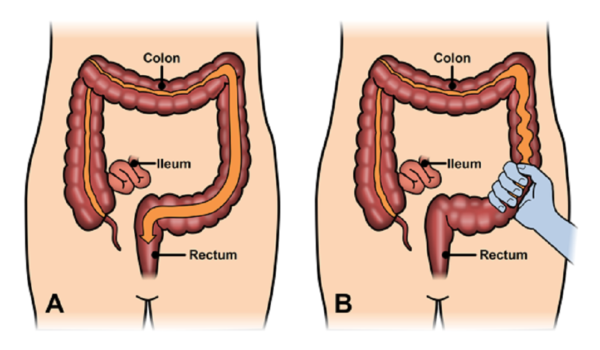 Hội Chứng Ruột Kích Thích Có Tự Khỏi Không? Tìm Hiểu Nguyên Nhân Và Cách Điều Trị Hiệu Quả