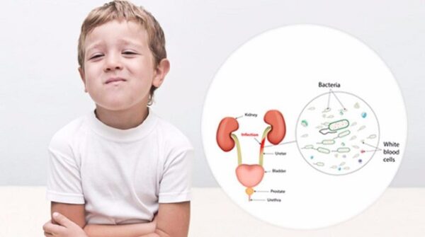 Viêm đường tiết niệu là bệnh nhiễm khuẩn thường gặp ở trẻ em
