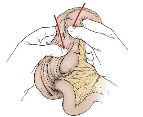 Thủ thuật tháo lồng điều trị bệnh tiêu hóa ở trẻ em