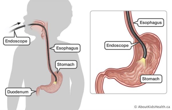 Nội soi dạ dày tá tràng chẩn đoán xuất huyết tiêu hóa trên ở trẻ 