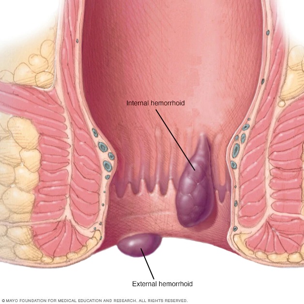 Hình ảnh búi trĩ nội (bên trên) và trĩ ngoại (bên dưới)