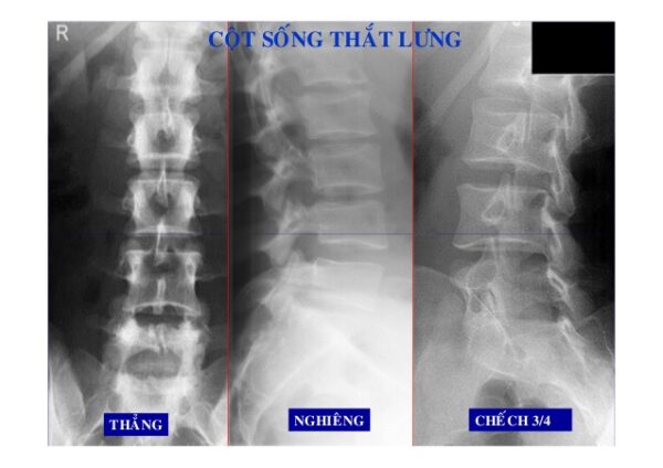 Chụp X-quang cột sống thắt lưng là phương pháp chẩn đoán không xâm lấn và an toàn để xác định tình trạng sức khỏe của bạn. Xem bức ảnh này để hiểu rõ hơn về kết quả xét nghiệm của bạn.