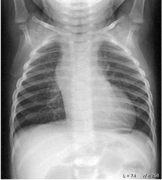 chụp x quang phổi cho bé có hại không