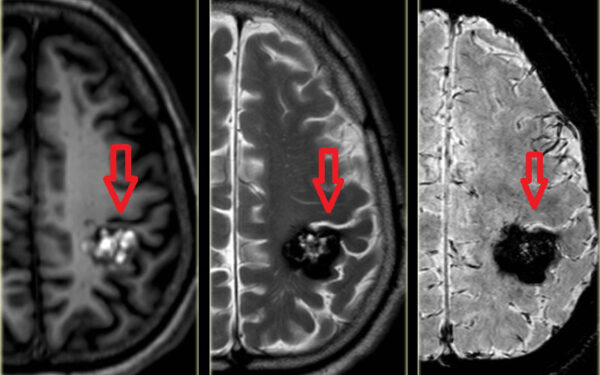 Chụp cộng hưởng từ não - “trợ thủ đắc lực” chẩn đoán bệnh về não