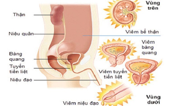 Viêm đường tiết niệu ở nam giới là tình trạng viêm nhiễm các cơ quan của hệ tiết niệu