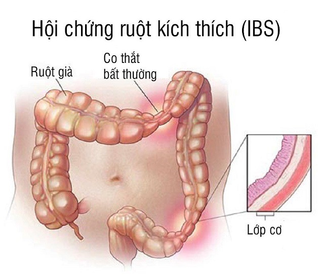 Hội chứng ruột kích thích đang khiến đại tràng chúng ta co thắt như thế nào?