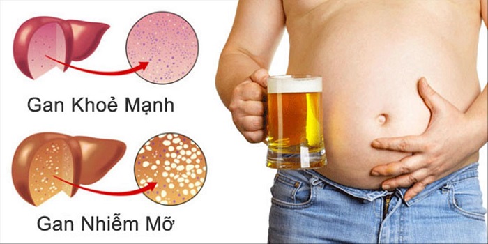 Rượu bia là nguyên nhân chính gây gan nhiễm mỡ độ 2